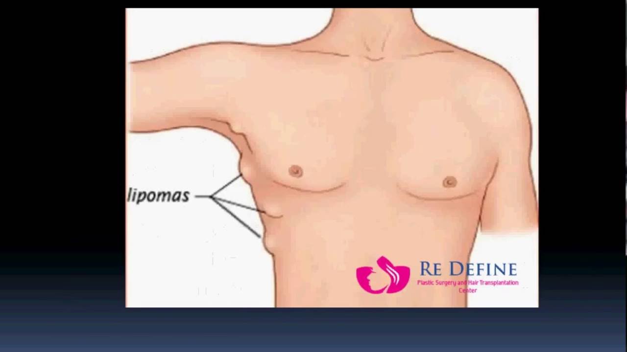 Lipoma removal the most effective method 44 Lipoma removal the most effective method 69