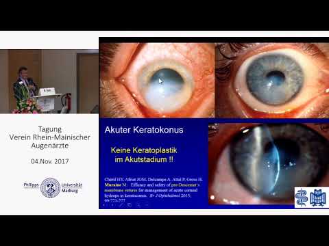 Prof. Berthold Seitz: Neues aus dem Homburger Keratokonus Center HKC 11-2017