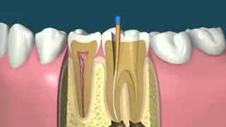 River Road Dental: Root Canal Treatment