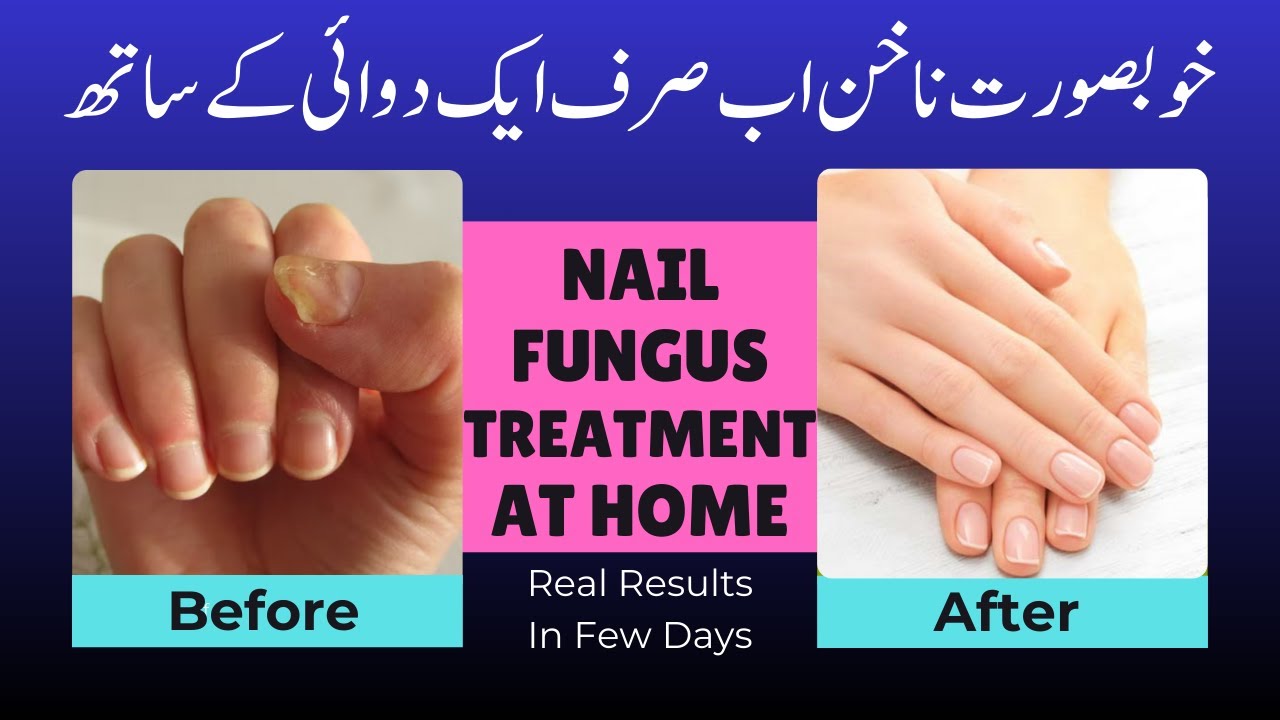 The ABSOLUTE BEST Way to Treat Fungal Nail Infection at Home
