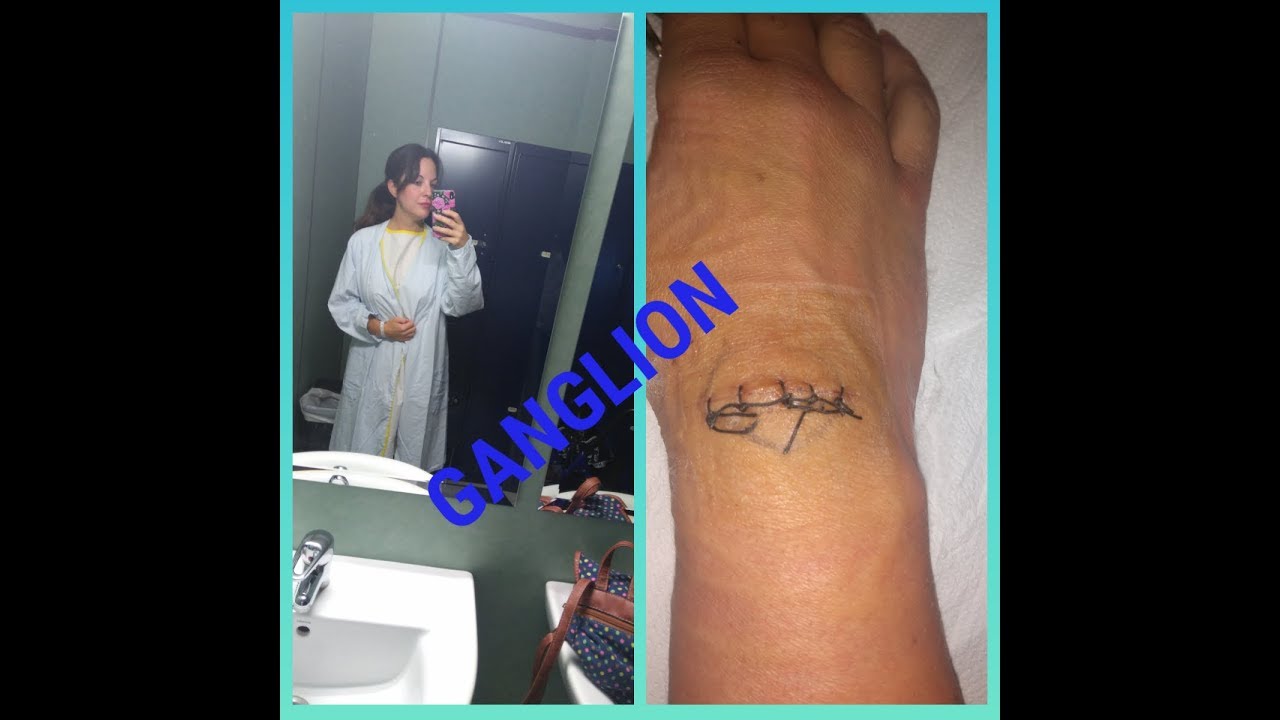 OPERACION DE GANGLION EN LA MUÑECA - YouTube