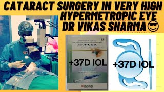 CATARACT SURGERY IN HIGHLY HYPERMETROPIC ( SMALL) EYE  (+37 D IOL IMPLANTATION) #eyes #shorts #short