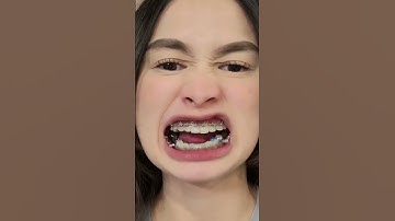 Khí cụ niềng răng gì mà cồng kềnh quá dậy | WaterBeam #tamnuocwaterbeam #shortvideo