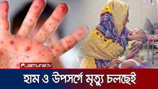 সারাদেশে হাম ও উপসর্গ নিয়ে আরও ২ জনের মৃত্যু | Measles | news | JamunaTV
