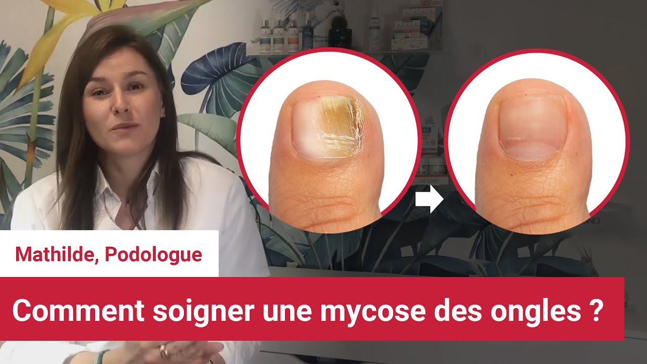 MYCOSE ONGLE : guérir la mycose des ongles (pied, gros orteil…) –  Dermatologue en téléconsultation