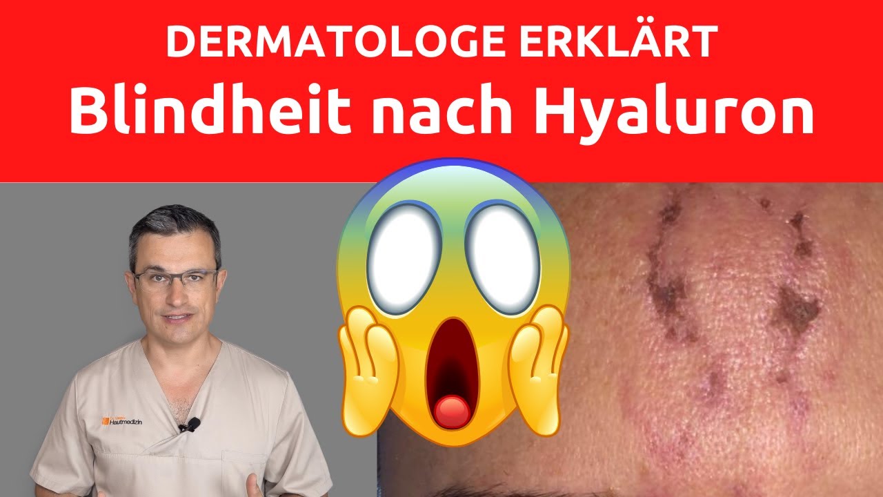 Natürliche Lip Filler Behandlung \u0026 Unterspritzung der Marionettenfalten 2022 (4K)