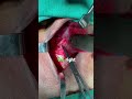 RLN and Inferior Thyroid artery | Short Video Education | Ep 05