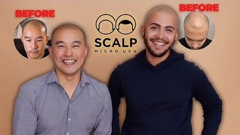 Scalp Micropigmentation is the #1 Solution for Hair Loss