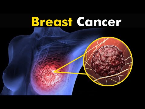 What Happens in Breast Cancer? | Symptoms And Treatment (Urdu/Hindi)