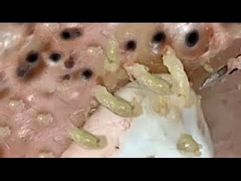 Pimple Popping 2020 Video #40| Blackheads removal, Acne removal, acne