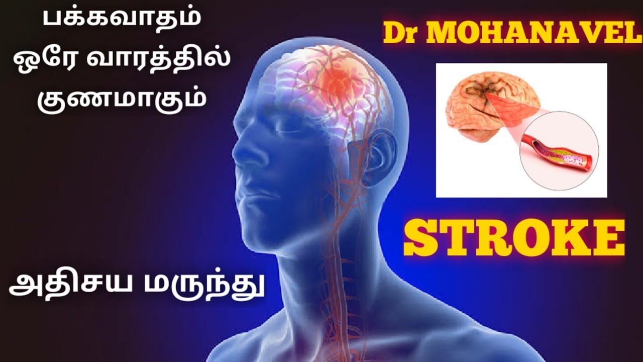Emergency 02 Stroke பக்கவாதம் How to Cure அறிகுறிகள்