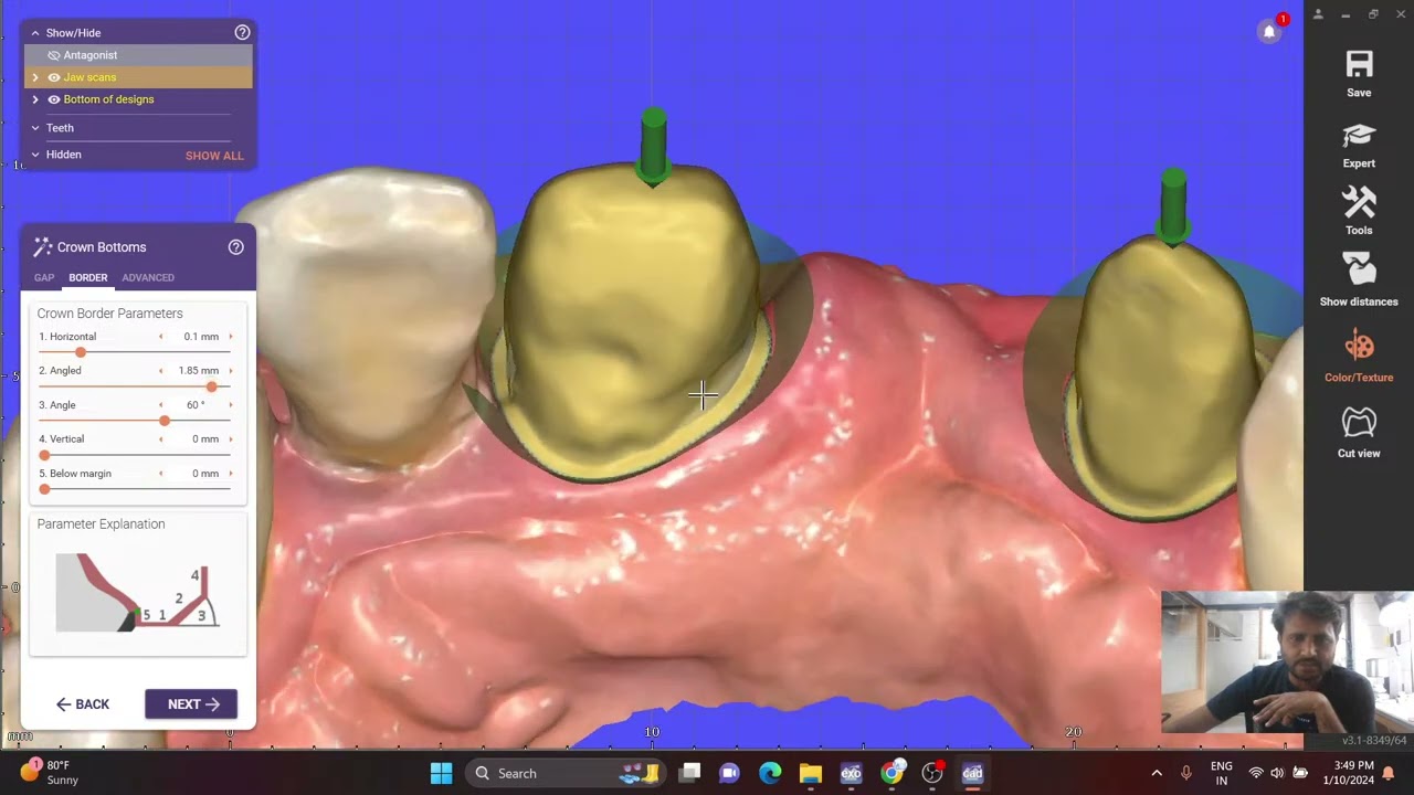 Copy of exocad crown design in hindi/#single crown design in exocad/#exocad galway