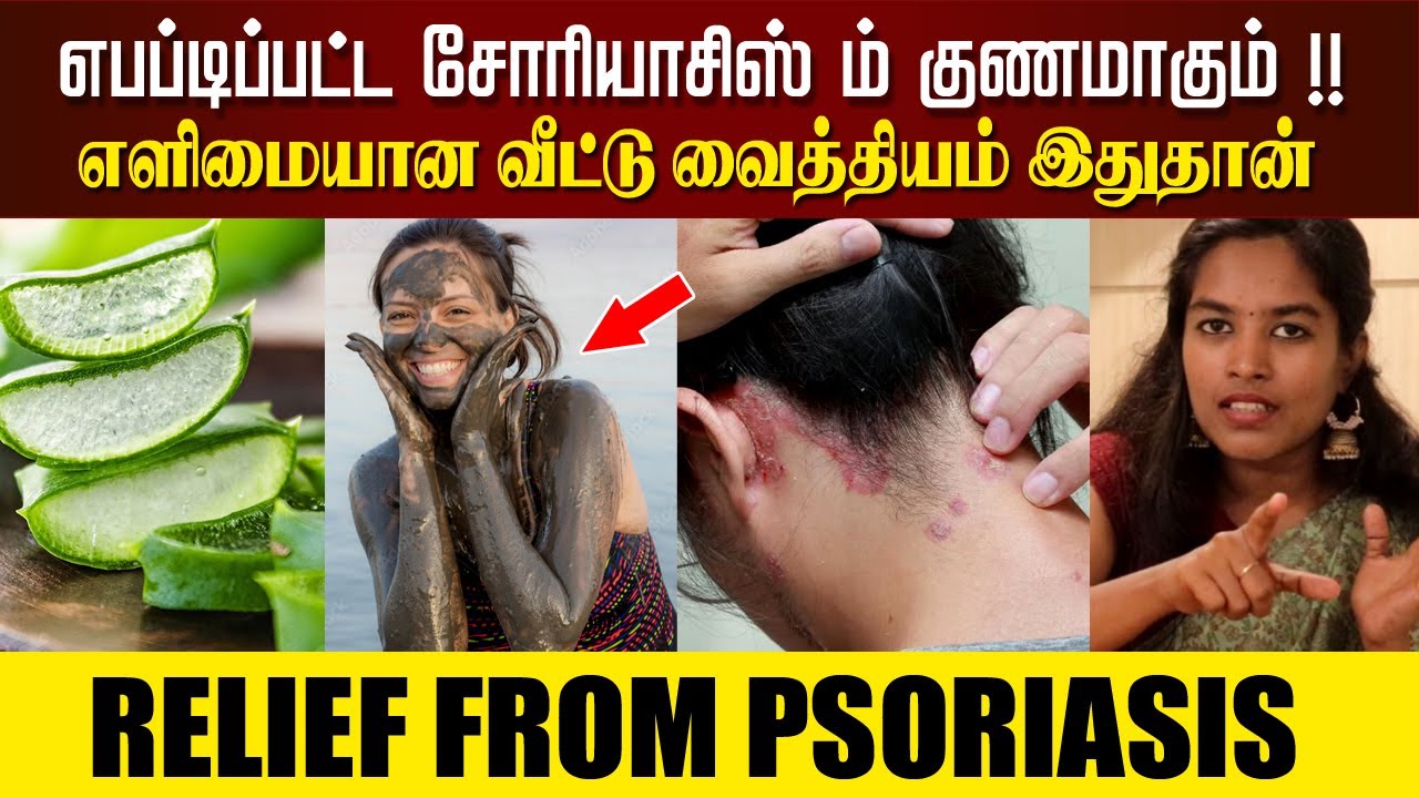 Psoriasis Treatment | இதை செஞ்சா எபப்டிப்பட்ட சோரியாசிஸ் ம் குணமாகும் | Dr.Ponshamili