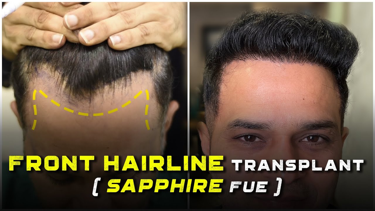 FUE Hairline Design How To Get A 100 Natural Hair Transplanted HairLine   YouTube