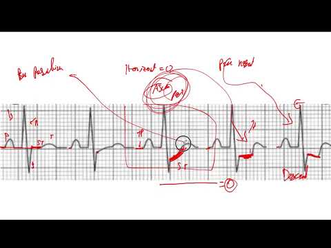Video: ¿Qué es la depresión del segmento s-t?