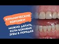 Керамические коронки! Можно делать, если боковые зубы в порядке.