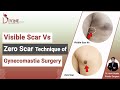 Gynecomastia surgery scar vs zero scar technique  scarless technique for male breast reduction