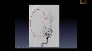 Thrombectomy for Acute Ischemic Stroke: Where we are.