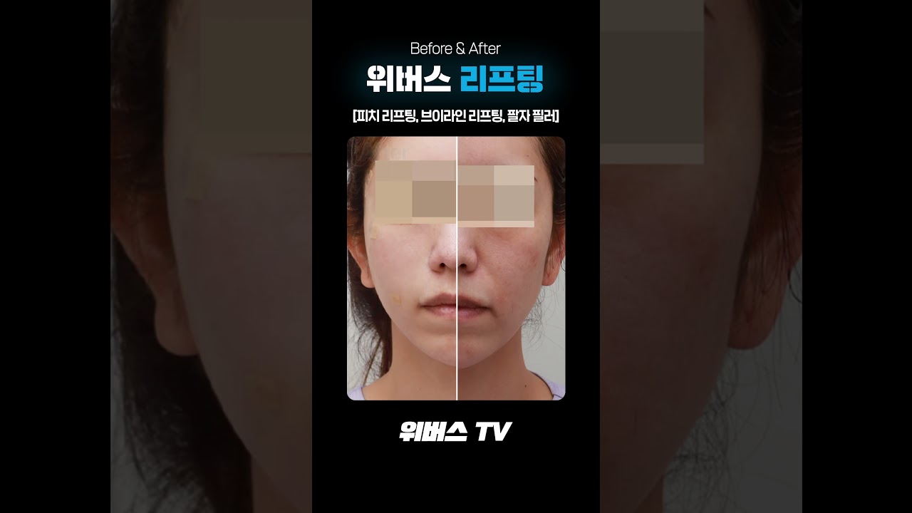 [Вивэрс гоо сайхны эмнэлэг] Залуулаг төрх, V хэлбэрийн нүүр, унжсан хацрын үрчлээсийг нэг дор шийдвэрлэ 😍