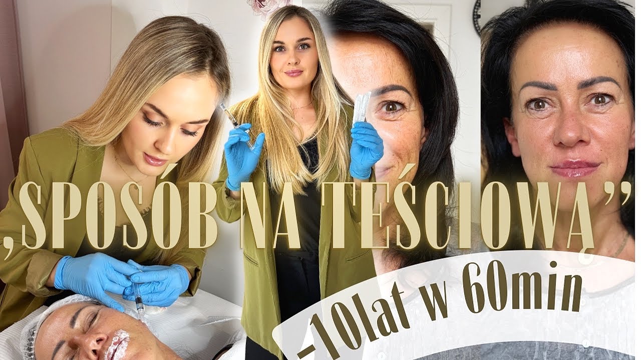 Odmłodzenie twarzy stymulatorem tkankowym + usta! - 