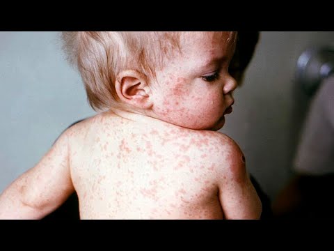 Корь охватила столицу Армении. Ситуация с каждым днем все тревожнее, медики призывают к вакцинации