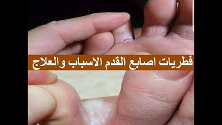 فطريات اصابع القدم/الاسباب /والعلاج