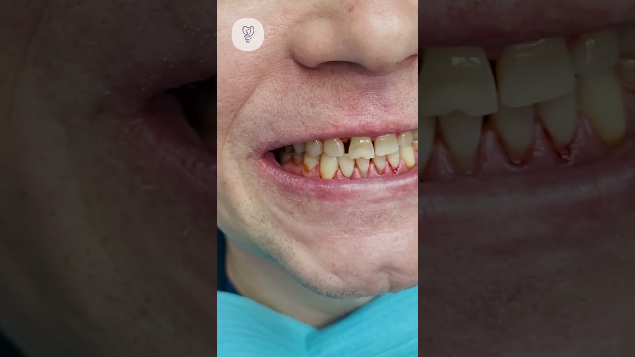 Задача сделать красивую улыбку. Планируем установить 13 виниров и один имплантат. Имплантация зубов.