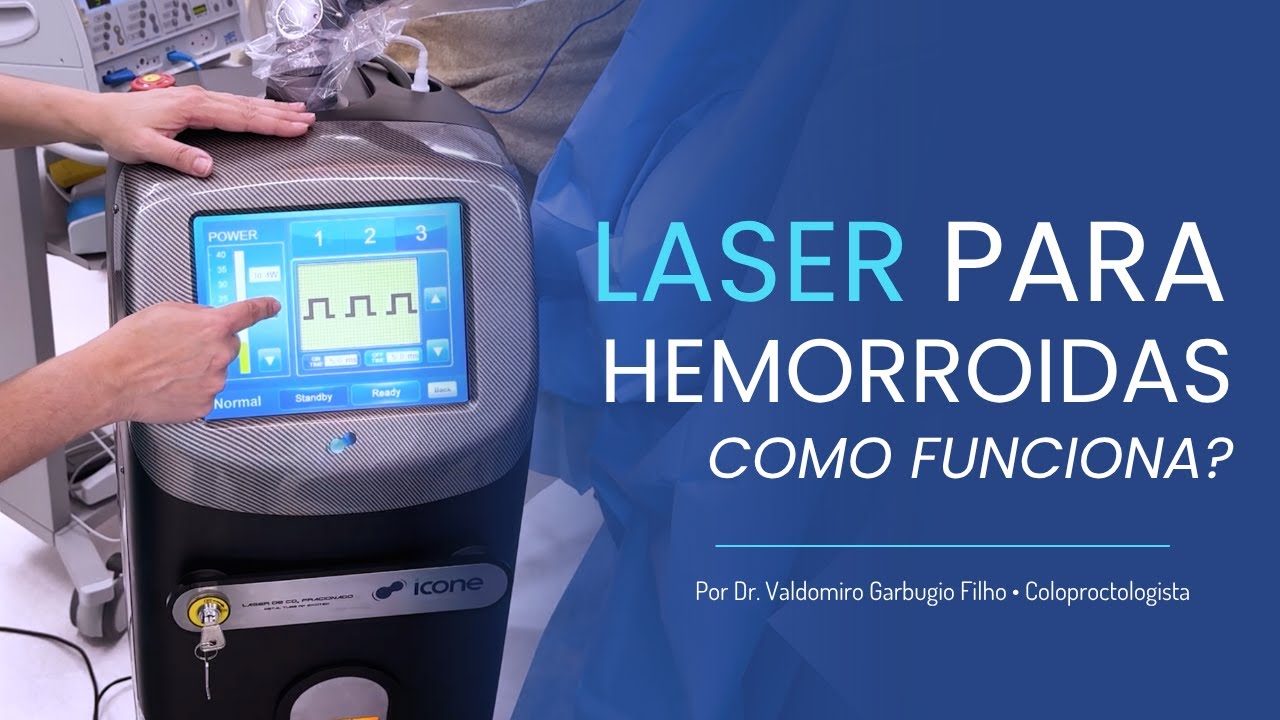 Como eu uso o LASER de CO2 no tratamento de plicomas e hemorroidas externas | Dr. Valdomiro