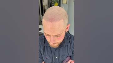 Scalp Micro Pigmentation 2nd Session! #scalpmicropigmentation Defined Hairline #besthair