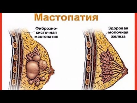 МАССАЖ МОЛОЧНЫХ ЖЕЛЁЗ! КАК ВЫЛЕЧИТЬ МАСТОПАТИЮ, КИСТЫ И БОЛИ В ГРУДЯХ!