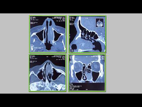 Video: Tumores Nasales: Asesinos Lentos E Insidiosos - Totalmente Examinado