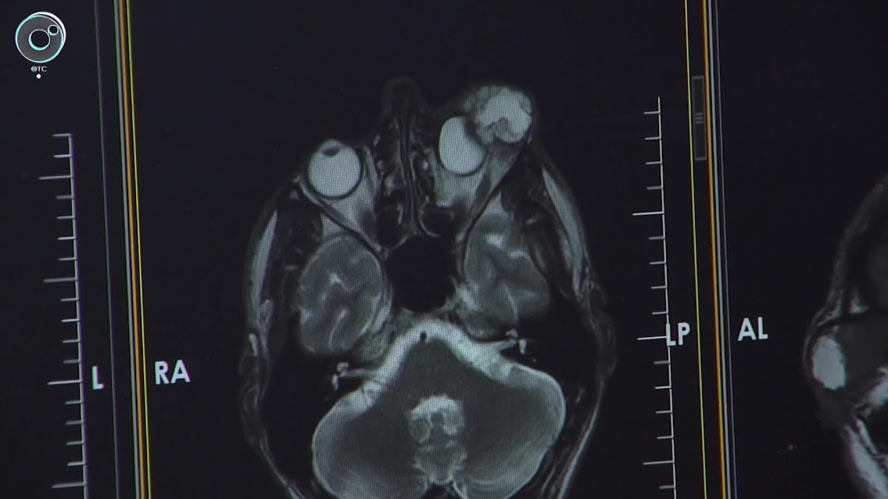 Как врачи смогли сохранить зрение пациенту с огромной опухолью?