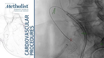 Iliac Branch Device and EVAR (Maham Rahimi, MD, M. Mujeeb Zubair, MD)