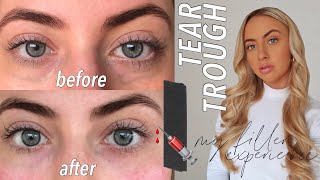 TEAR TROUGH FILLER: my experience &amp; results!! Kennedy Warden