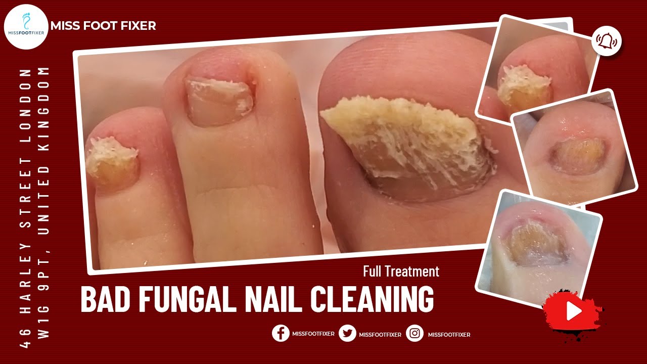 Fungal Nail Treatment Oil Foot Repair Essence Toe Nail Fungus Removal Gel  Anti Infection Cream Fungal Nail Removal - AliExpress