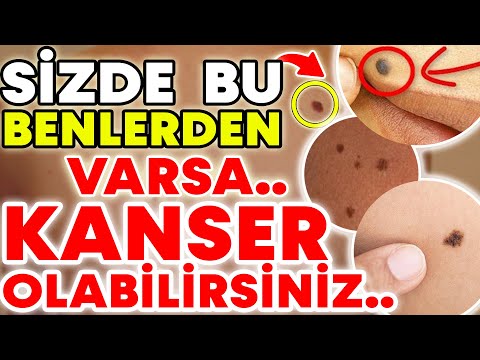 Bu benlerden sizde var ise kanser olabilirsiniz! - Benlerin en önemli işaretleri