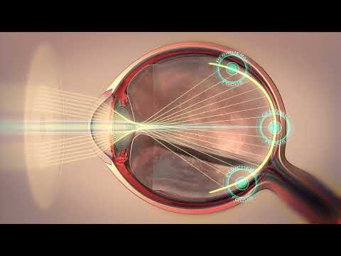 Myopia Control: MiyoSmart lens technology explained