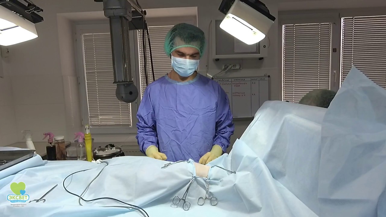 Диагностика и оперативное лечение дивертикула пищевода, вызванного персистирующей дугой аорты.