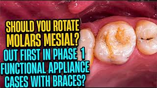 Rotating Molars Mesial -OUT Before Appliance Therapy