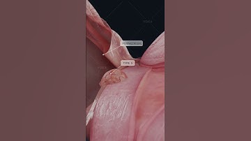 What are uterine fibroids? How do they affect your body?