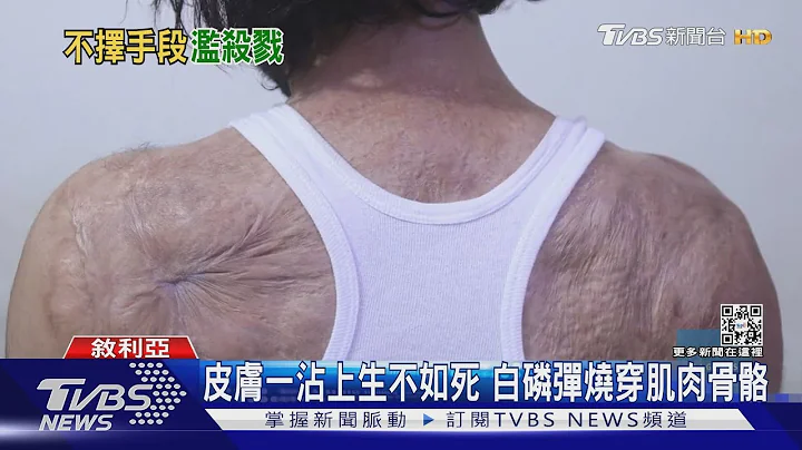 肤烧如剥洋葱 俄疑用化武“白磷弹” 下一步恐爆核战｜TVBS新闻 - 天天要闻