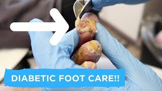 TAKING THE NAIL OFF?! **DIABETIC FOOT CARE**