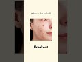 What is this called? Learn 6 common injury words in English. Quick, useful and real life vocabulary