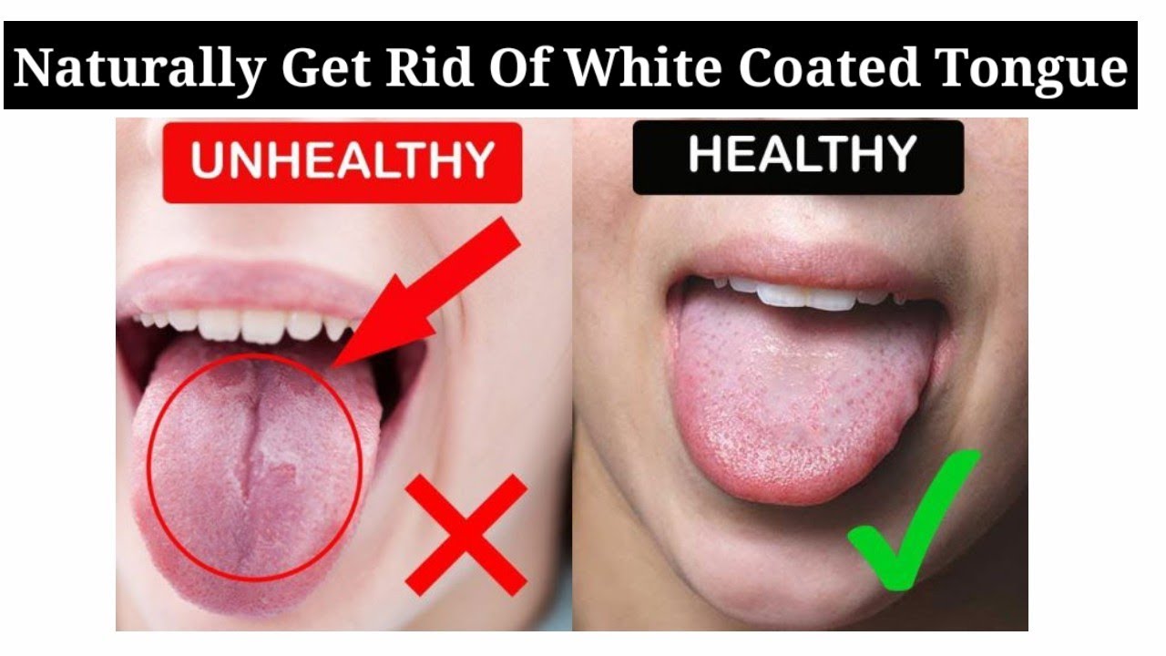 Natural Home Remedies To Get Rid Of White Tongue | Oral Candidiasis ...