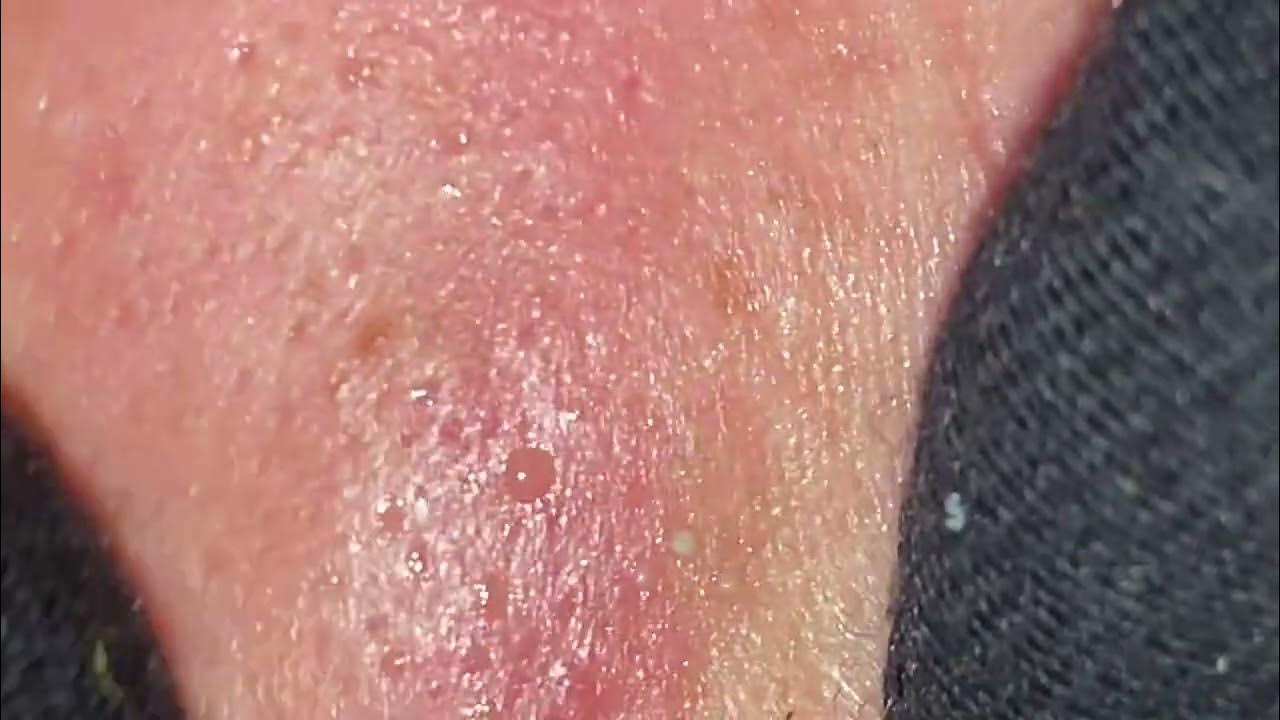 ベストニキビ潰しビデオ ASMR Nose Pimple Popping Best Pimple Popping Video