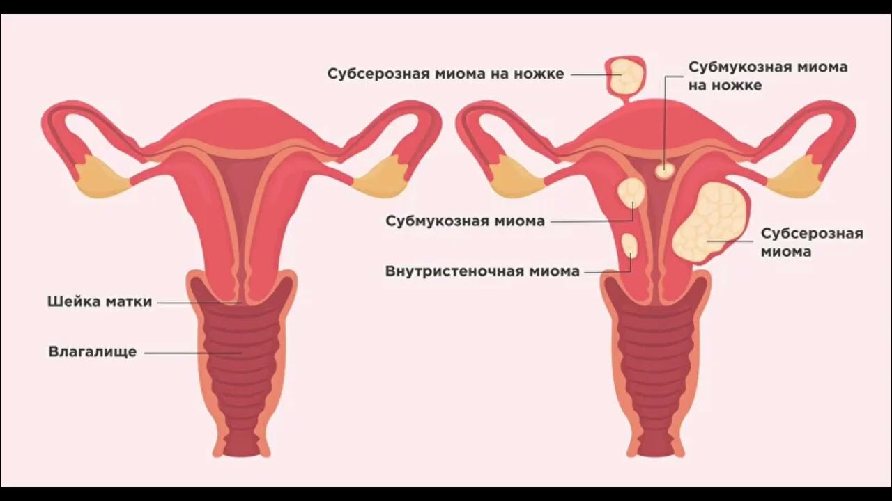 возможно забеременеть миома матки. миома матки питание диета. возможно забеременеть миома матки. миома матки и беременность. возможно забеременеть миома матки.