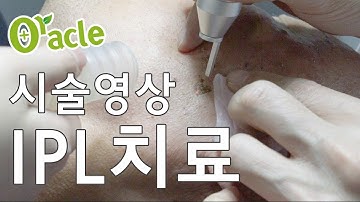 시술영상 IPL치료