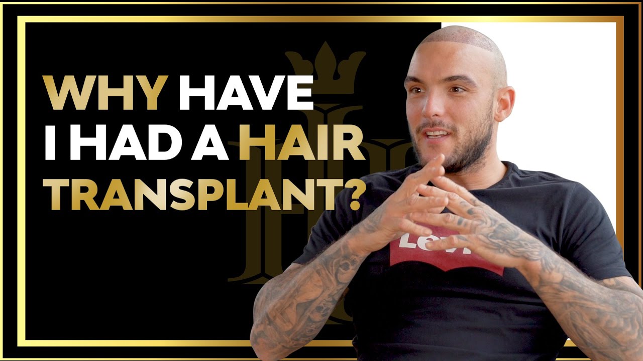 why-have-i-had-a-hair-transplant-hair-transplant-patient-from-united