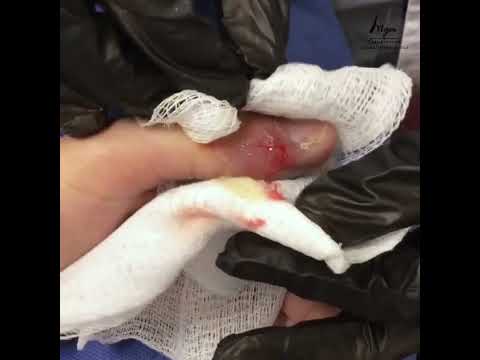 Video: ¿Te duele pincharte el dedo?