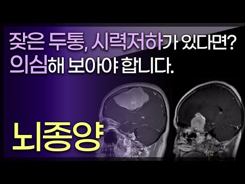 내머릿속의 침입자, 뇌종양/양성뇌종양-뇌수막종/악성뇌종양-신경교종,전이성뇌종양/뇌종양의 치료법/원발성뇌종양/TV닥터인사이드 부산MBC 150621 방송